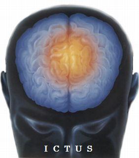 Ictus